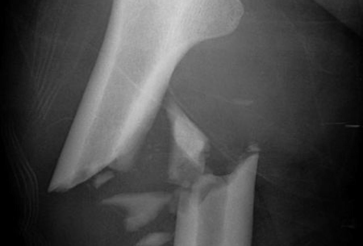 radiografia frattura femore
